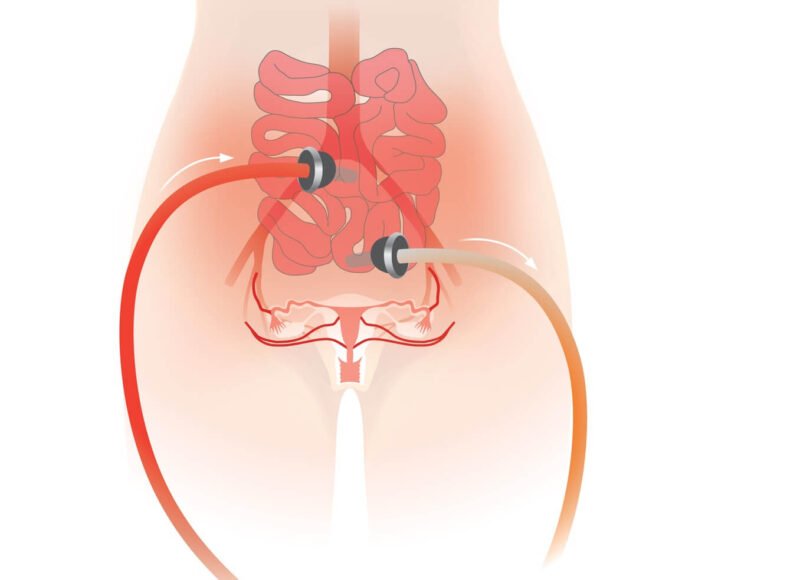 hipec ovarian Dr.Bartos