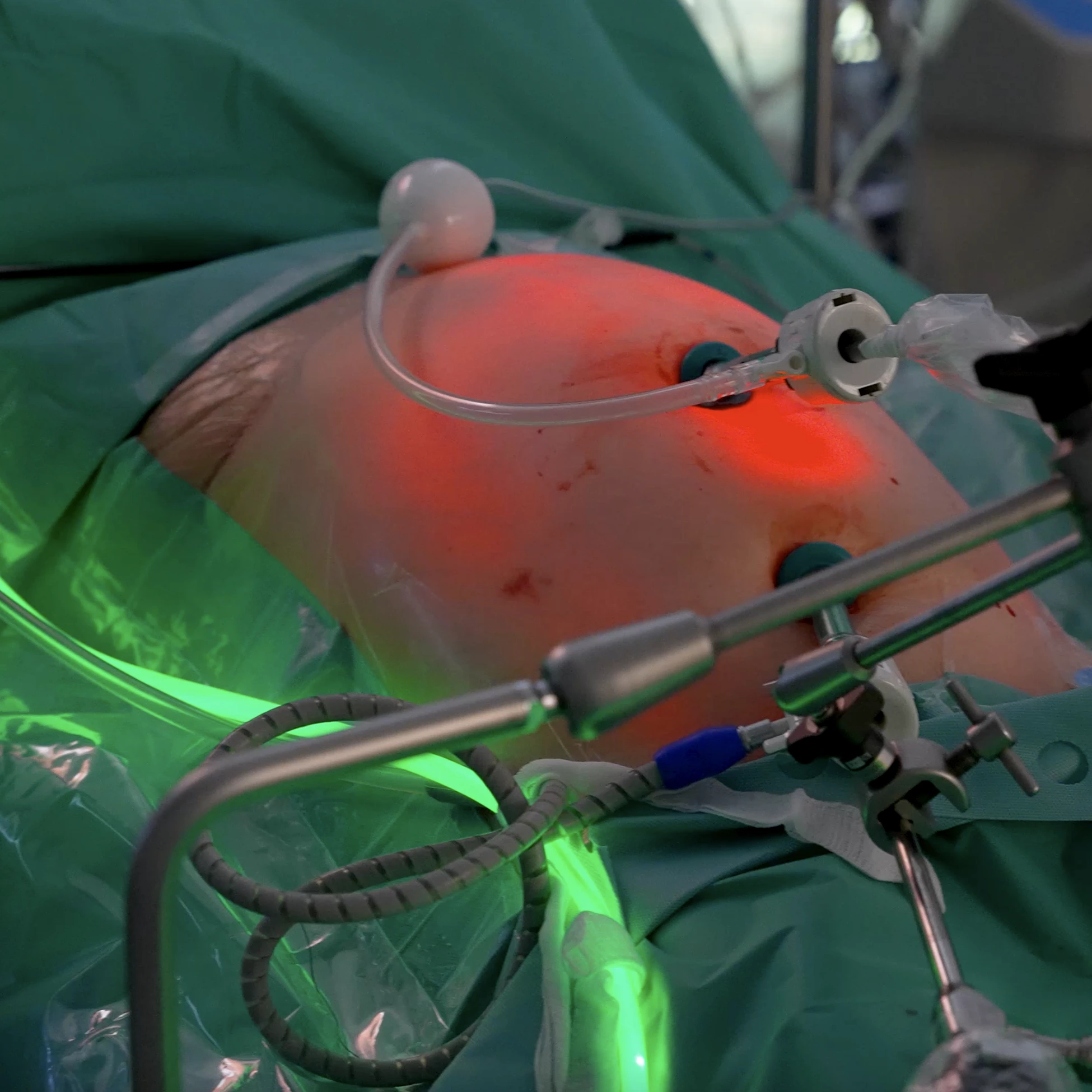 carcinomatoza peritoneala